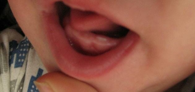 أعراض ظهور الأسنان عند الأطفال